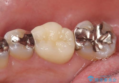 オールセラミッククラウン 他院にて根管治療を勧められた歯の治療の治療後