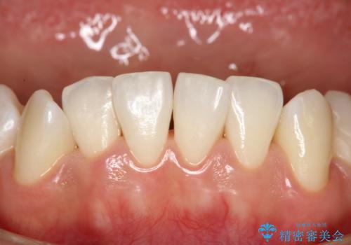 定期的にPMTCで口元ケアをの症例 治療後