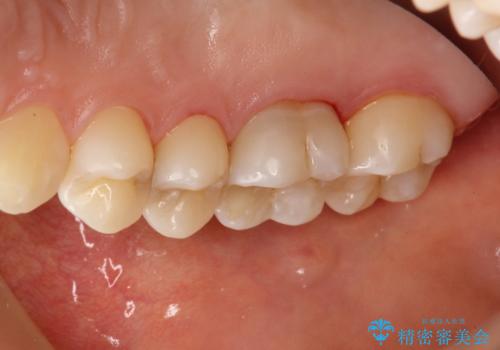 定期的にPMTCで口元ケアをの治療後