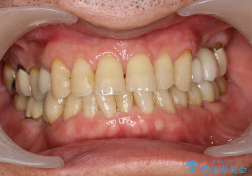 スペシャルホワイトニング3回照射の治療前