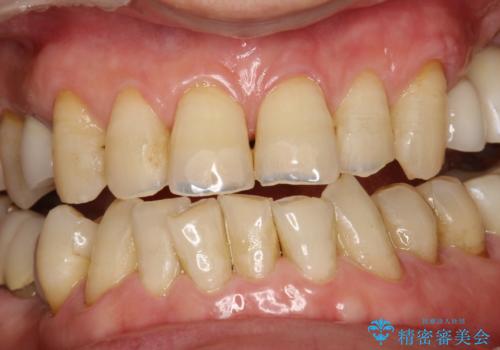 スペシャルホワイトニング3回照射の症例 治療前