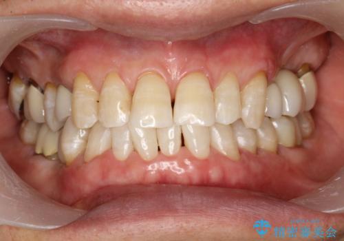 スペシャルホワイトニング3回照射の治療後