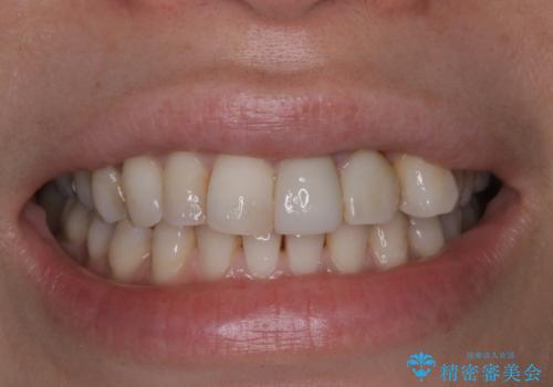 インビザライン アタッチメント設定前のPMTCの症例 治療前