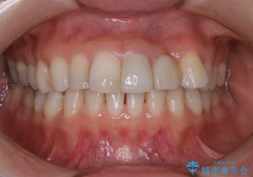 インビザライン アタッチメント設定前のPMTCの治療前