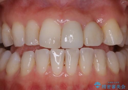 インビザライン アタッチメント設定前のPMTCの治療前