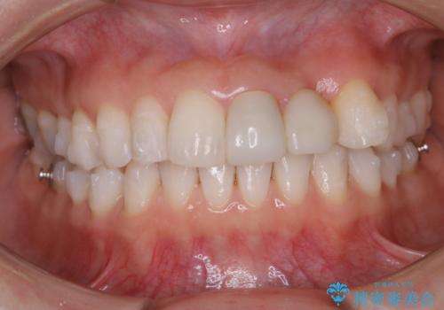 インビザライン アタッチメント設定前のPMTCの治療後