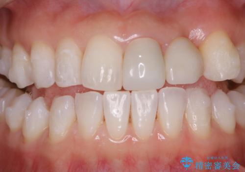 インビザライン アタッチメント設定前のPMTCの治療後