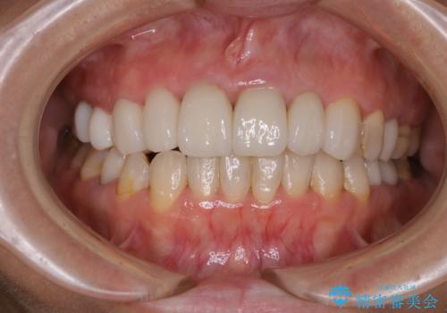 数年ぶりに歯科医院にて歯のクリーニングの治療前