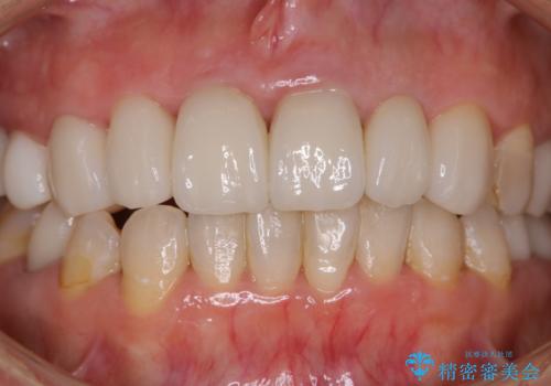 数年ぶりに歯科医院にて歯のクリーニングの治療前
