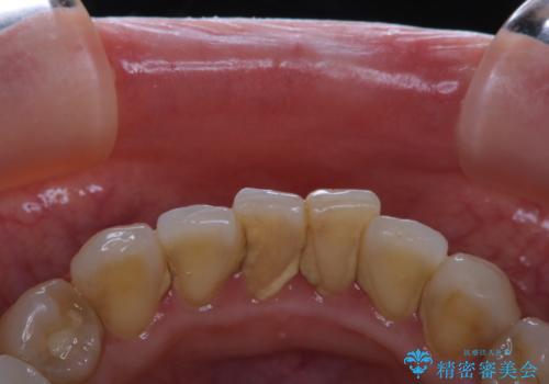 数年ぶりに歯科医院にて歯のクリーニングの症例 治療前