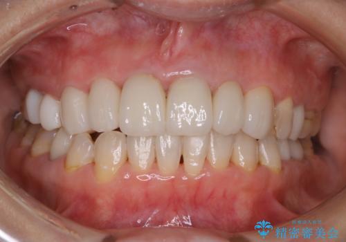 数年ぶりに歯科医院にて歯のクリーニングの治療後