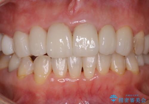 数年ぶりに歯科医院にて歯のクリーニングの治療後