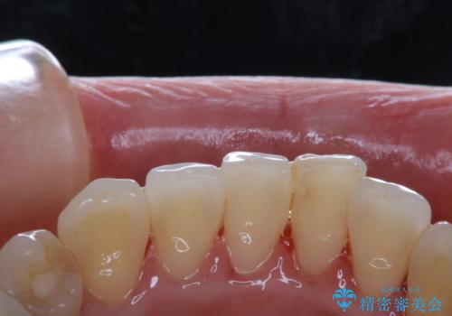 数年ぶりに歯科医院にて歯のクリーニングの症例 治療後