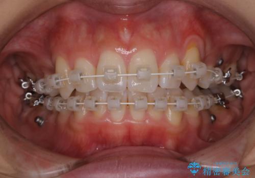 ワイヤー矯正中のPMTCで虫歯・歯周病・口臭予防の治療前