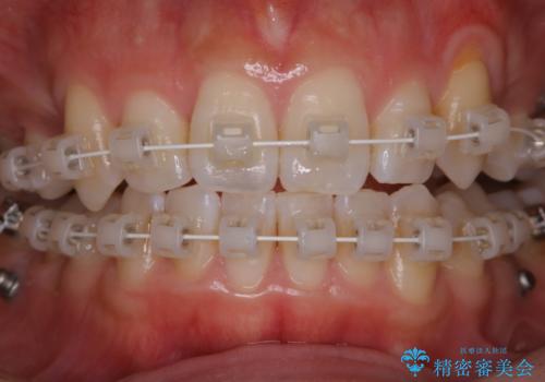 ワイヤー矯正中のPMTCで虫歯・歯周病・口臭予防の治療前