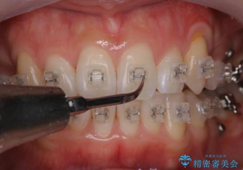 ワイヤー矯正中のPMTCで虫歯・歯周病・口臭予防の治療中