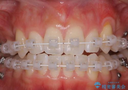 ワイヤー矯正中のPMTCで虫歯・歯周病・口臭予防の治療後