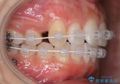 ワイヤー矯正中のPMTCで虫歯・歯周病・口臭予防の治療後