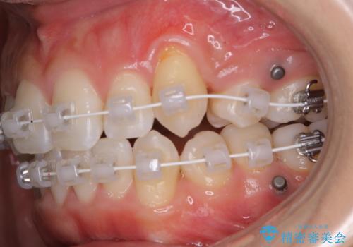 ワイヤー矯正中のPMTCで虫歯・歯周病・口臭予防の治療後