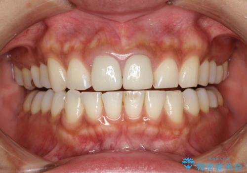 30分のPMTCで前歯の着色落としの治療前