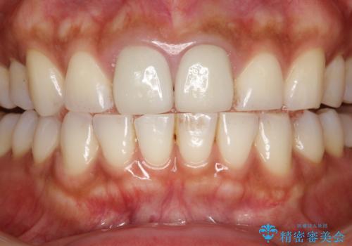 30分のPMTCで前歯の着色落としの症例 治療前