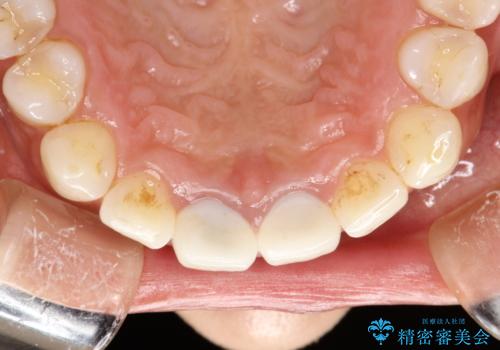 30分のPMTCで前歯の着色落としの治療前