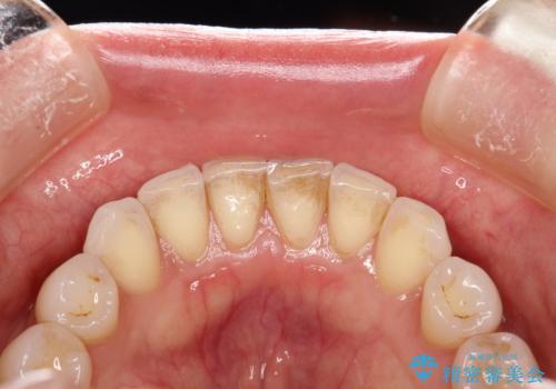 30分のPMTCで前歯の着色落としの治療前