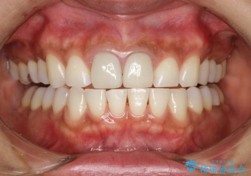 30分のPMTCで前歯の着色落としの治療後