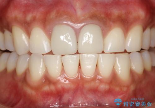 30分のPMTCで前歯の着色落としの症例 治療後