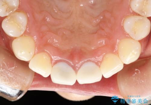 30分のPMTCで前歯の着色落としの治療後