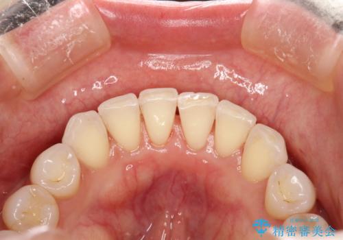 30分のPMTCで前歯の着色落としの治療後