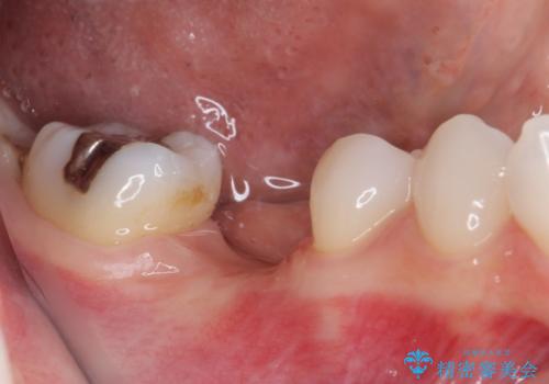 折れてしまった奥歯 下の奥歯のインプラント治療の治療中