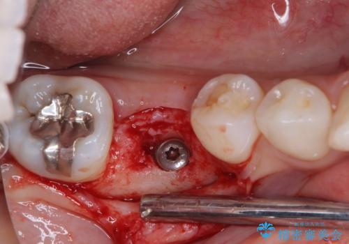 折れてしまった奥歯 下の奥歯のインプラント治療の治療中