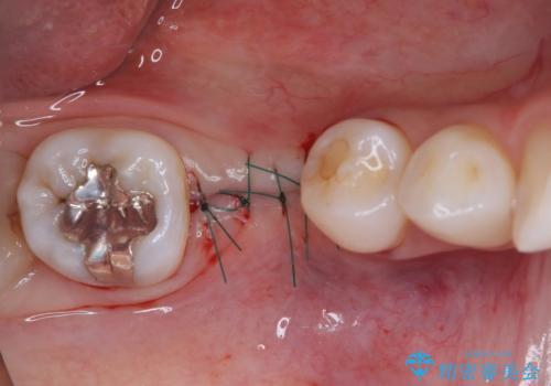 折れてしまった奥歯 下の奥歯のインプラント治療の治療中