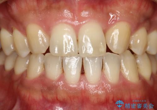 ステイン除去 PMTCの治療前