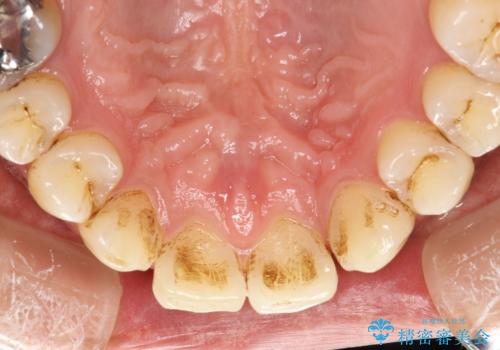 ステイン除去 PMTCの症例 治療前