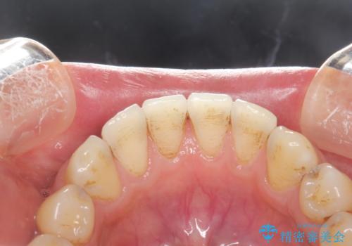 ステイン除去 PMTCの治療前