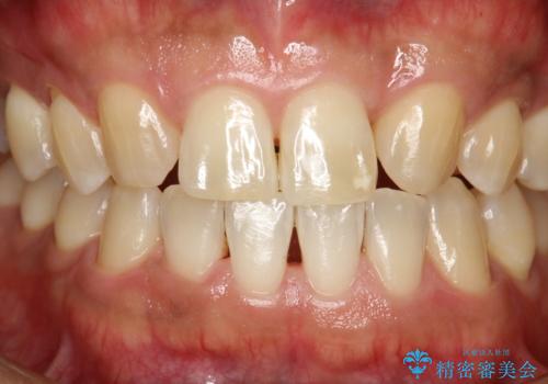 ステイン除去 PMTCの治療後