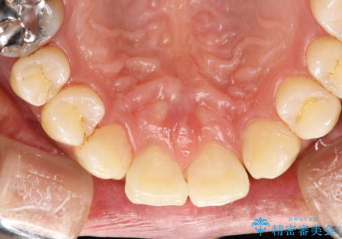 ステイン除去 PMTCの症例 治療後