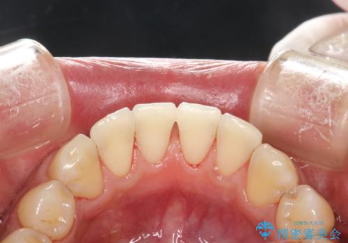 ステイン除去 PMTCの治療後