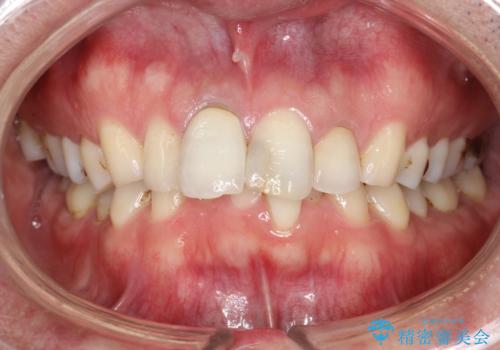 3年ぶりに歯科医院でお掃除 PMTCの治療前