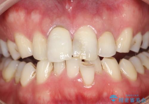 3年ぶりに歯科医院でお掃除 PMTCの治療前