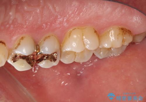 3年ぶりに歯科医院でお掃除 PMTCの治療前