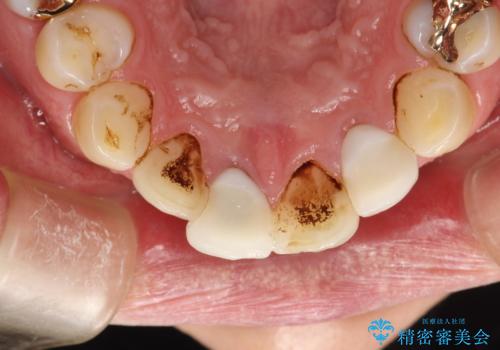 3年ぶりに歯科医院でお掃除 PMTCの症例 治療前