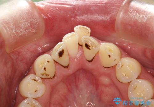 3年ぶりに歯科医院でお掃除 PMTCの治療前