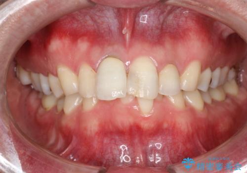 3年ぶりに歯科医院でお掃除 PMTCの治療後