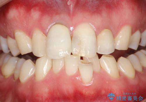 3年ぶりに歯科医院でお掃除 PMTCの治療後