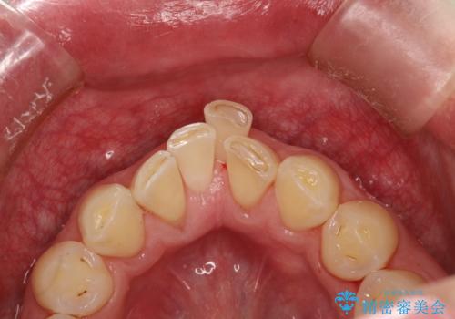 3年ぶりに歯科医院でお掃除 PMTCの治療後