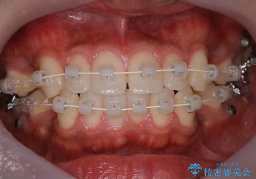 ワイヤー矯正中のクリーニング pmtcの治療後