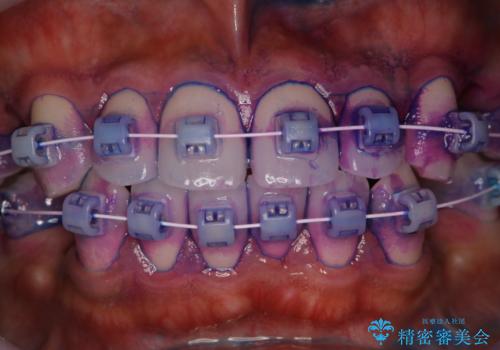 ワイヤー矯正中のクリーニング pmtc